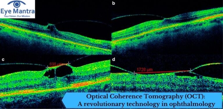 Optical Coherence Tomography OCT A Revolutionary Technology