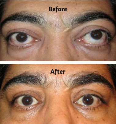 Squint Eye Treatment For Adults Causes And Risks Eyemantra