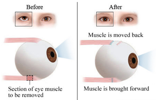 Squint eye treatment
