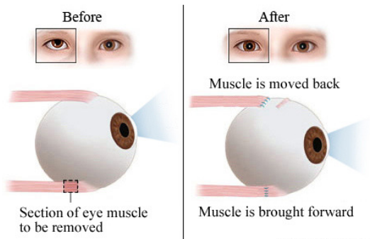 Squint Eye Treatment For Adults Causes Methods And Risks 