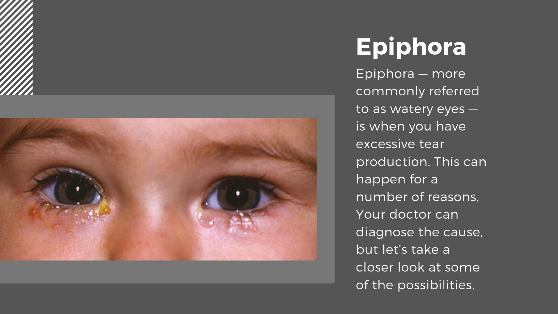 Ephiphora: What Causes Teary Eyes?