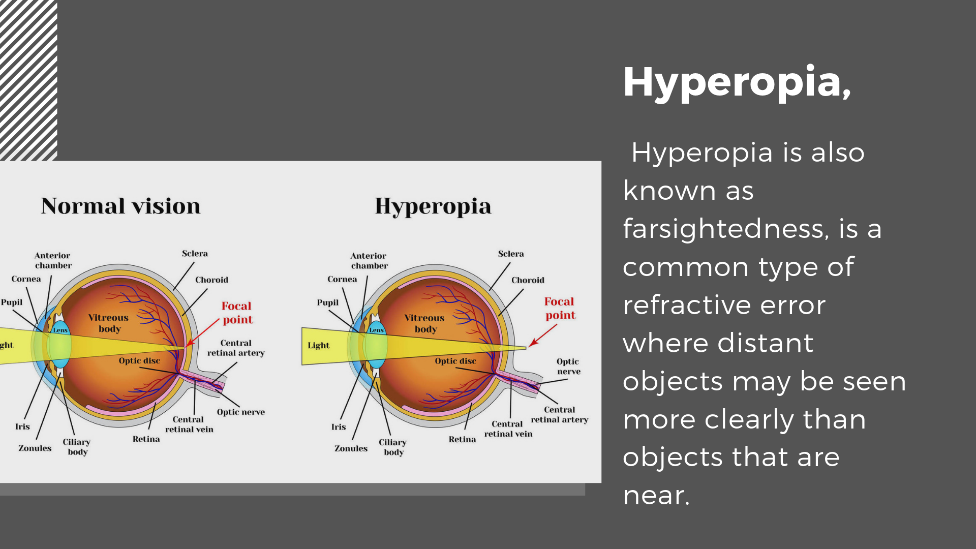 Children’s Eye Diseases