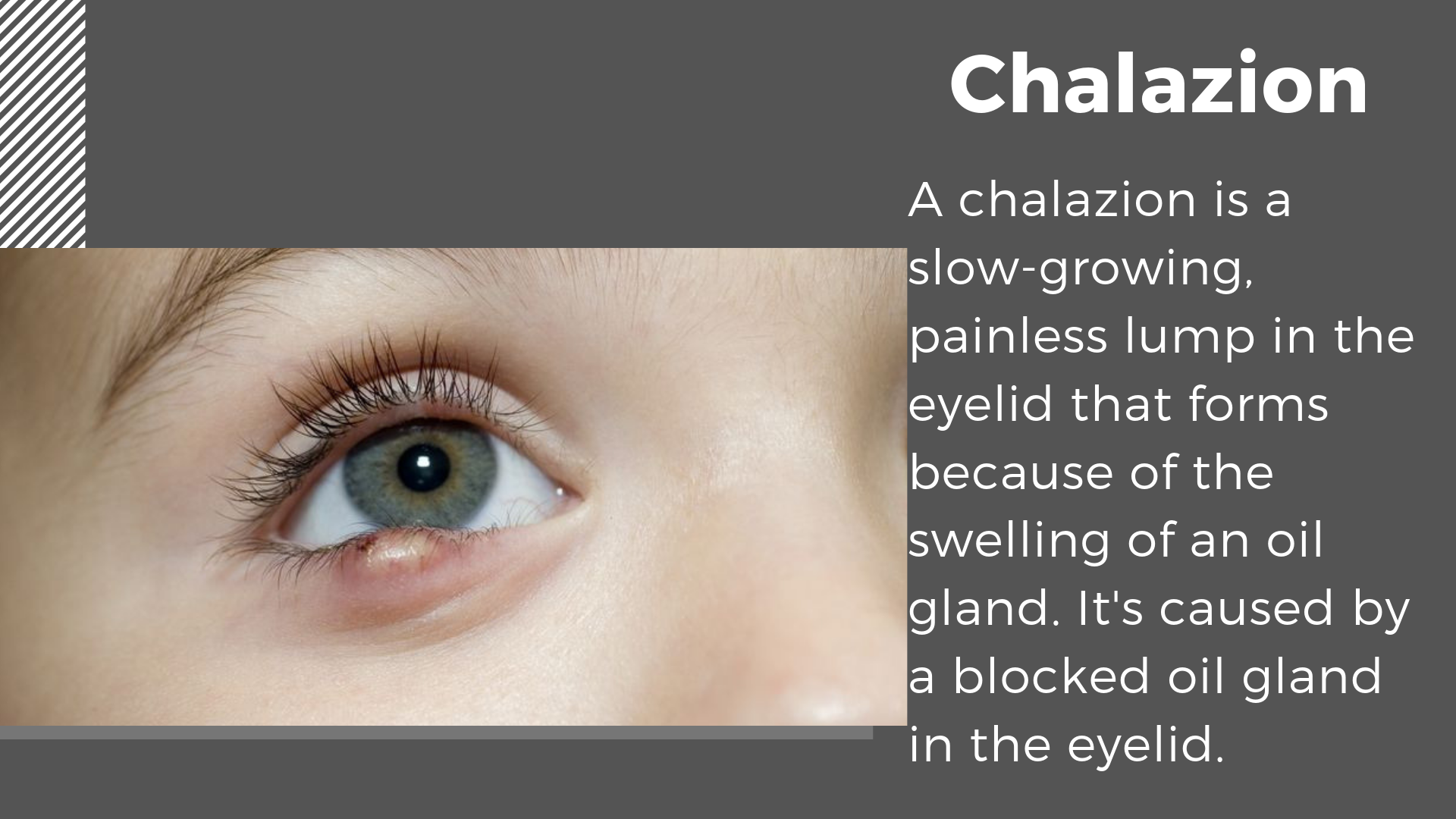 Children’s Eye Diseases