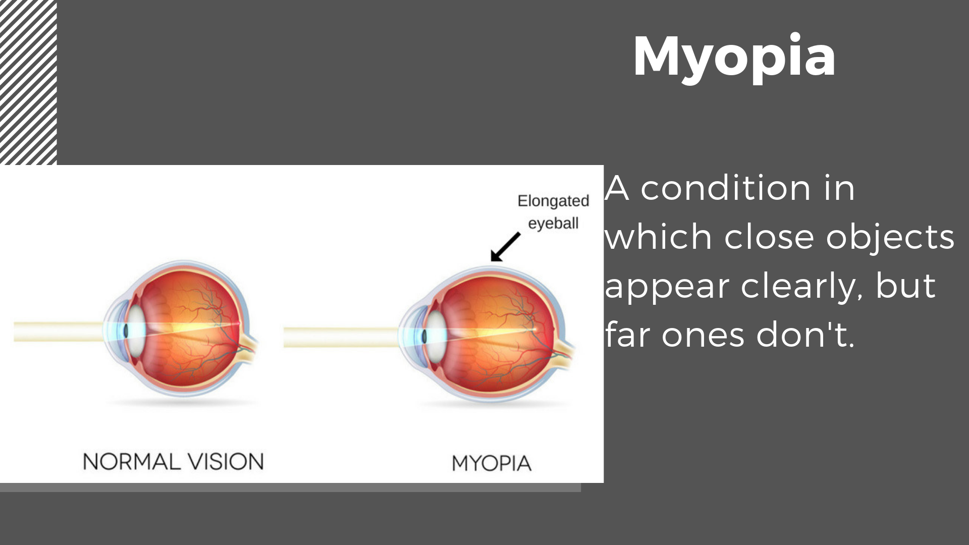 Children’s Eye Diseases