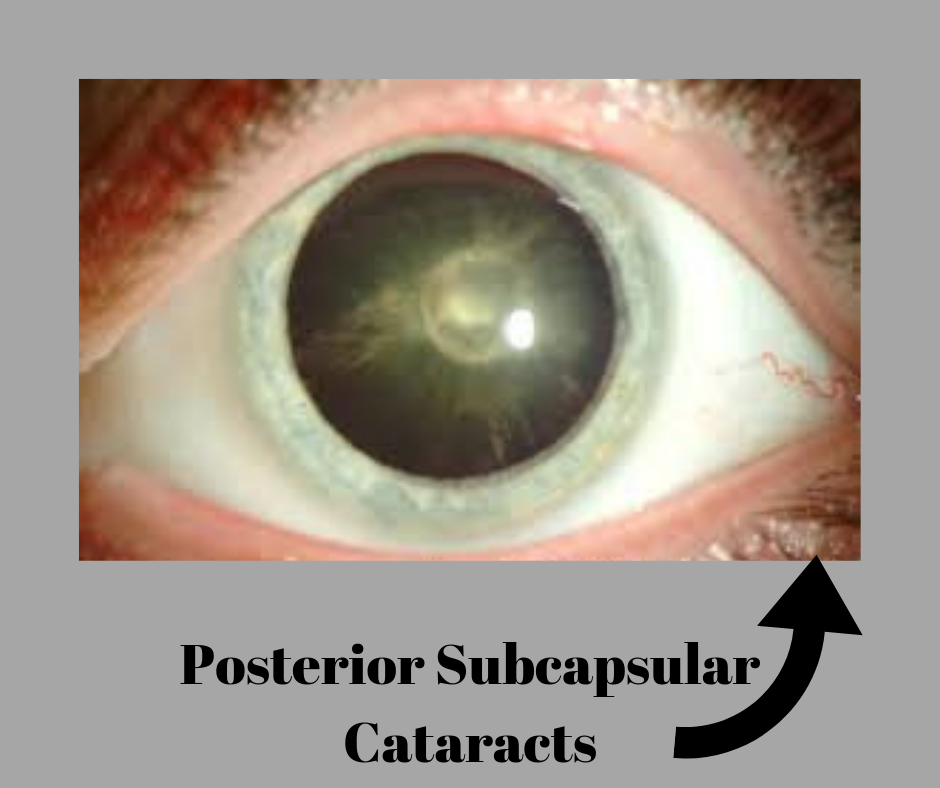 Cataract Surgery cost, types, phaco, zepto | Eyemantra