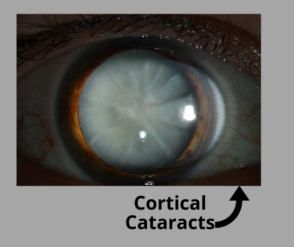 cataracts surgery