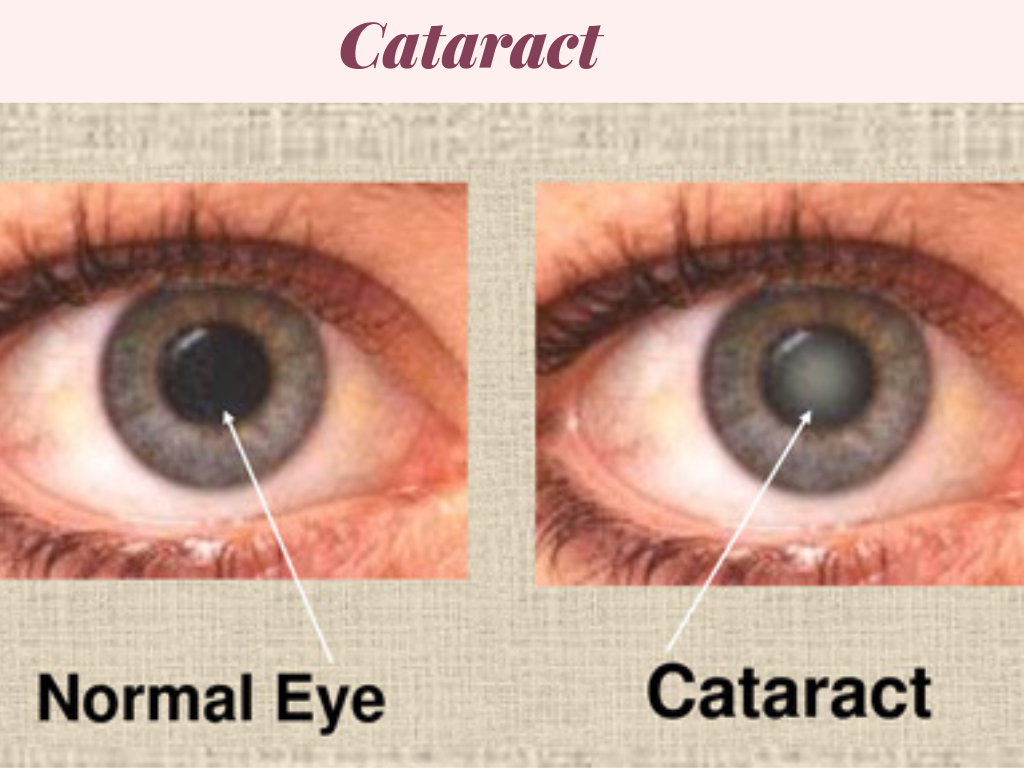 cataract prevention 