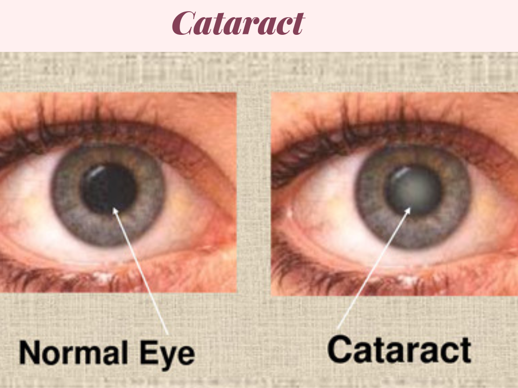 cataract