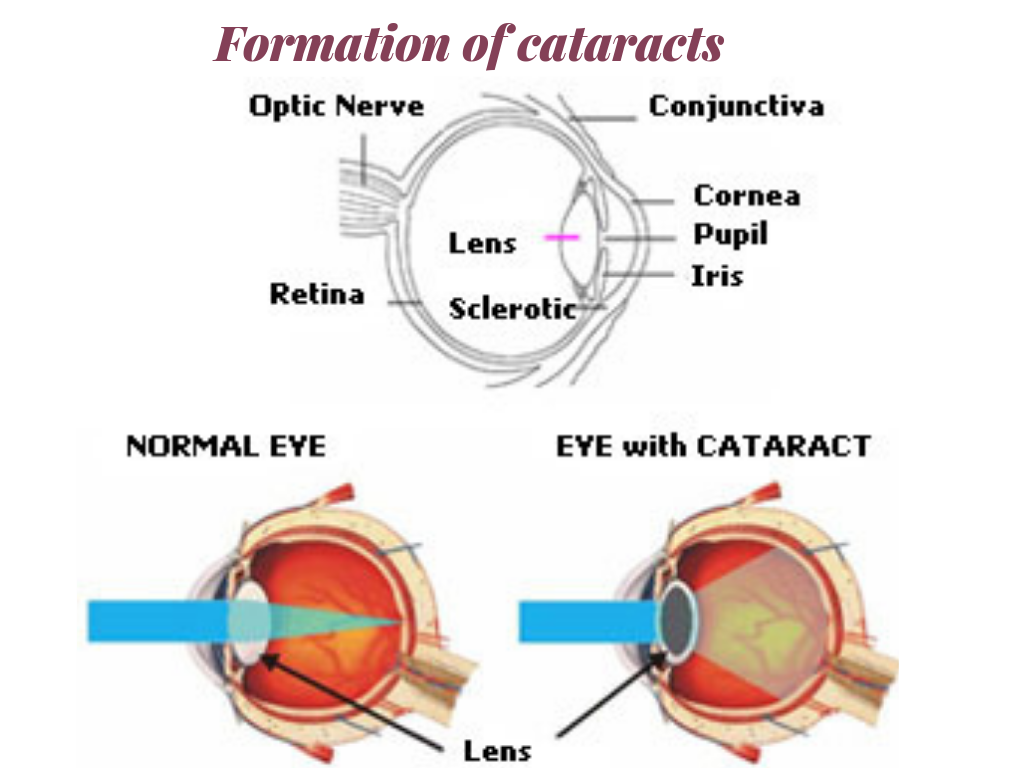 formation of cataract
