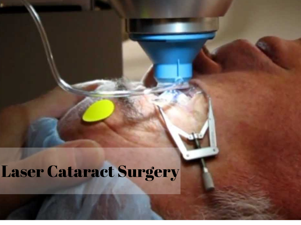 cataracts surgery