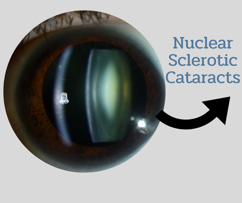cataracts surgery