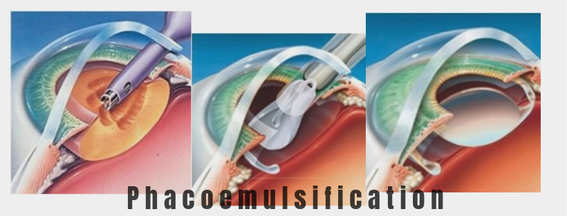 cataract surgery