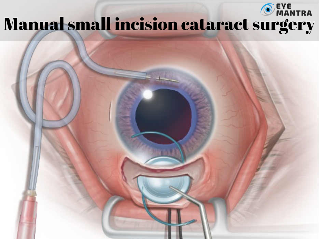 cataracts surgery