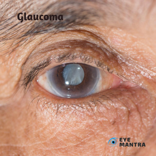 Glaucoma