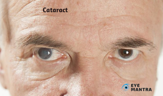 Cataract | Eye Mantra