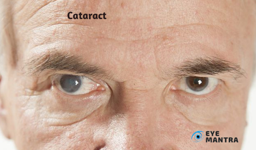 Cataracts