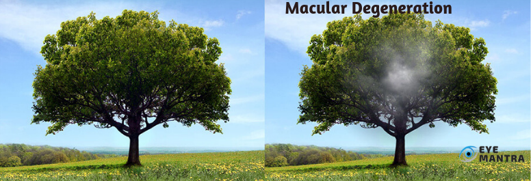 Age-related Macular Degeneration