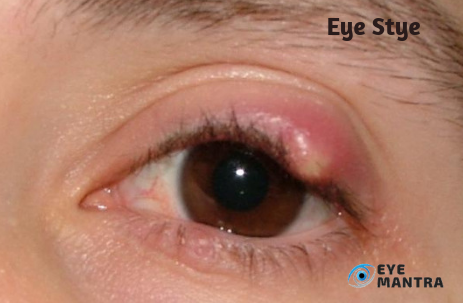 Eye diseases