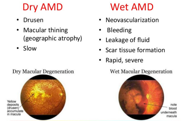 dry vs wet macular degeneration