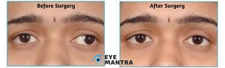 Eye Muscle Surgery Before And After Pictures