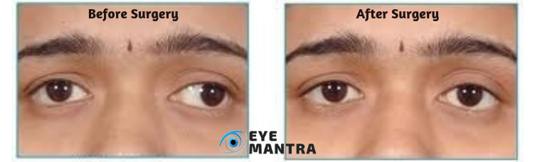 Eye Muscle Surgery | Facts, Procedure, Recovery and Risks