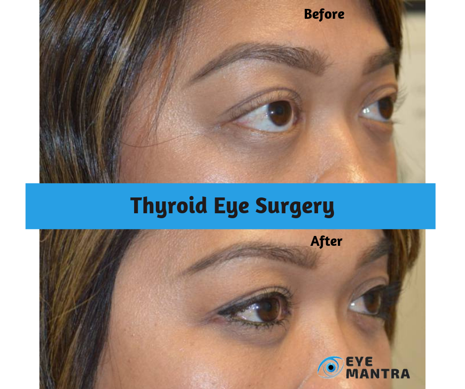 what-is-thyroid-eye-disease-and-can-it-be-treated-lowcountry-eye