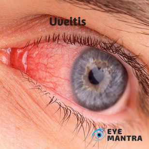 Uveitis | Eye Mantra