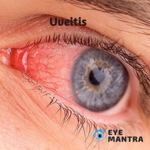 Uveitis