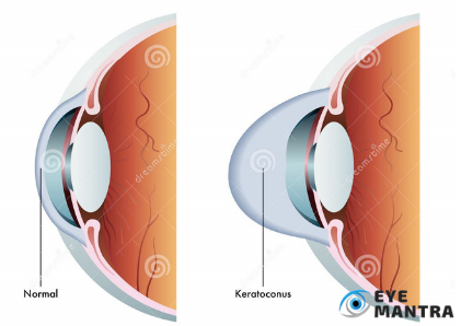 Keratoconus