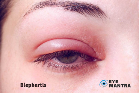 Blepharitis