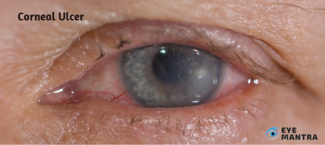 Corneal Ulcer