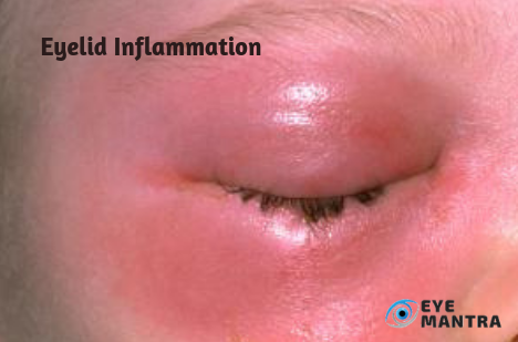 Eyelid Inflammation