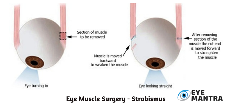 Eye muscle repair Information