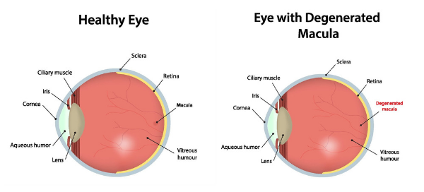 Macular Degeneration