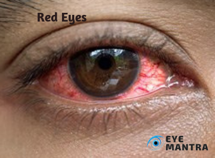 Eye diseases