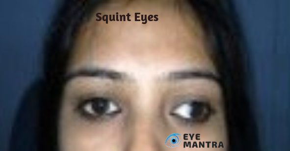 Squint Eyes