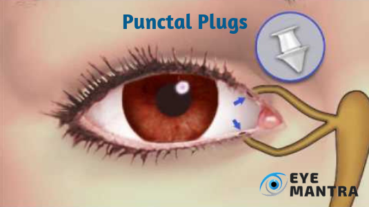 Punctal Plugs