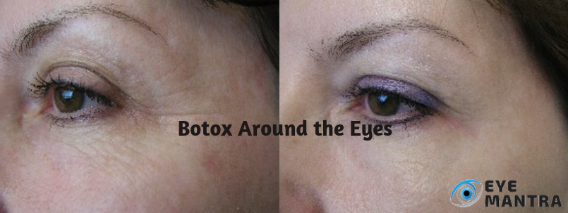 eye botox