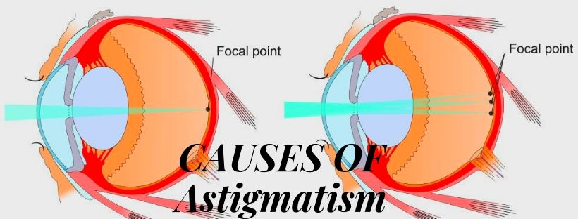 Astigmatism Causes, Symptoms & Treatment Eyemantra