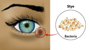 Causes of Eye Styes
