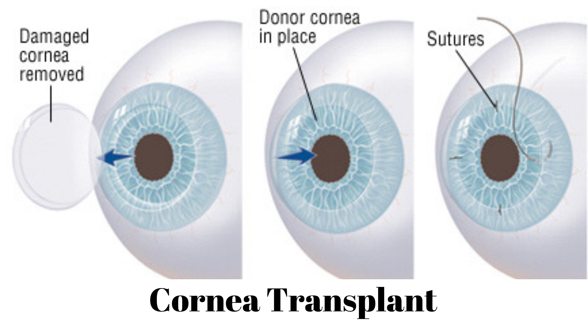 Cornea Transplant