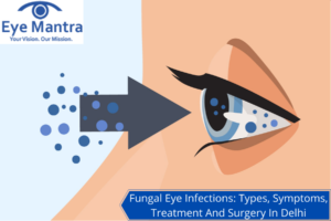 Fungal Eye Infection