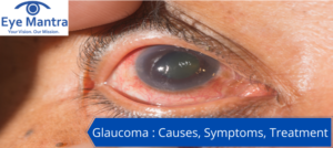 Glaucoma Causes, Symptoms, Treatment