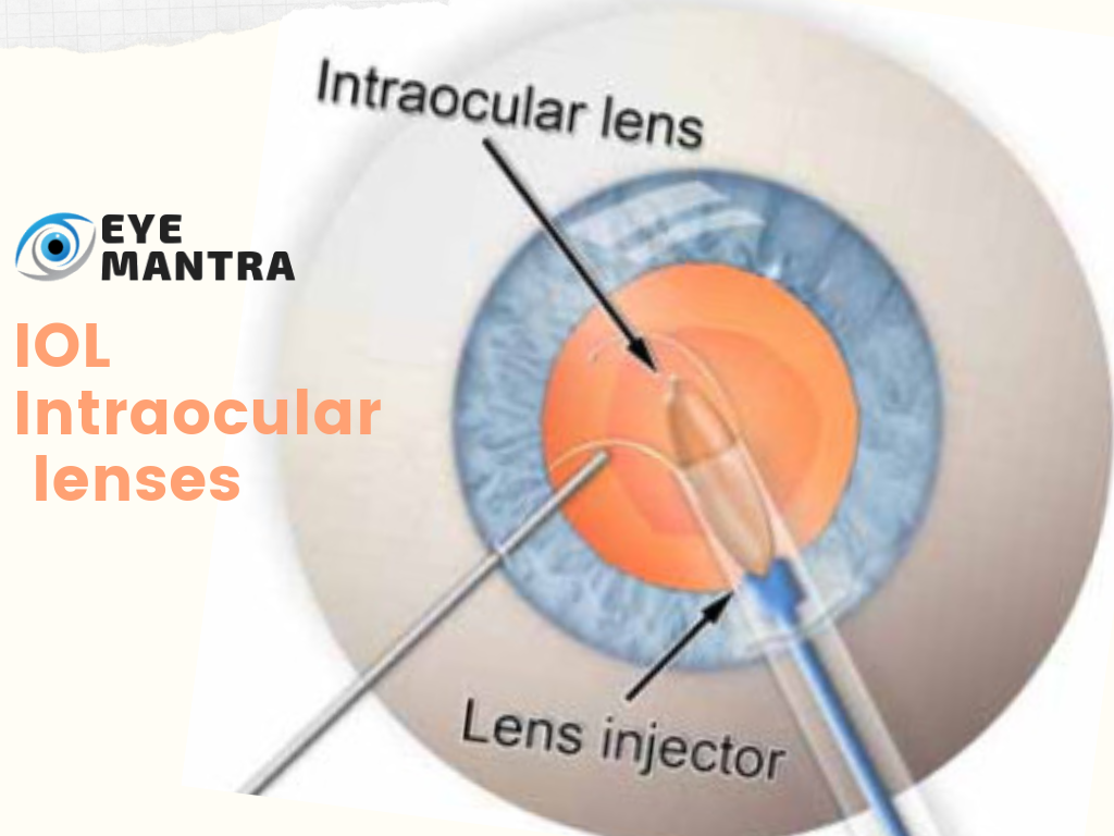 lasik vs iol