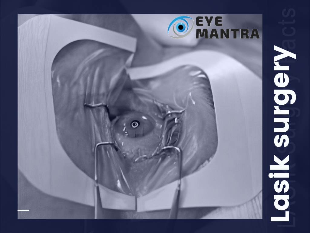 Lasik Vs Iol Point Of Differenciation Of Lasik And Iol Eyemantra