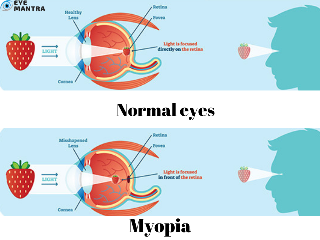 myopia causes agyrázkódás homályos látás
