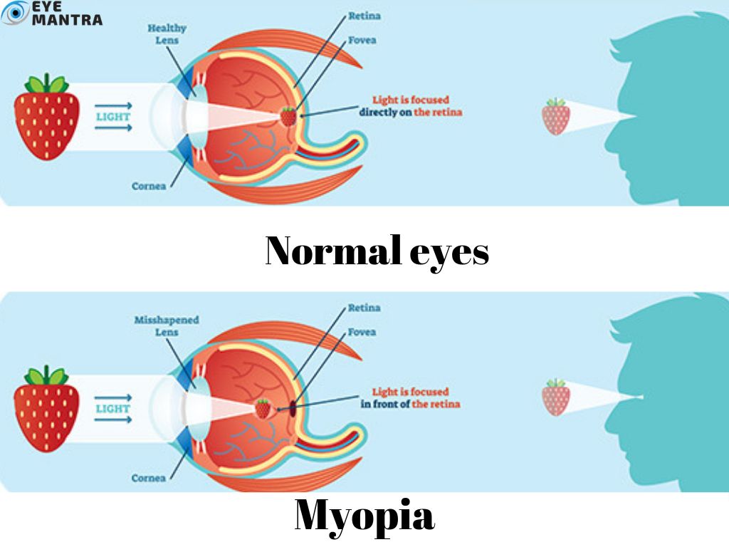 Myopia: Symptoms, Causes And Treatment | Nearsightedness