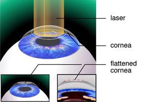 PRK correct refractive surgery