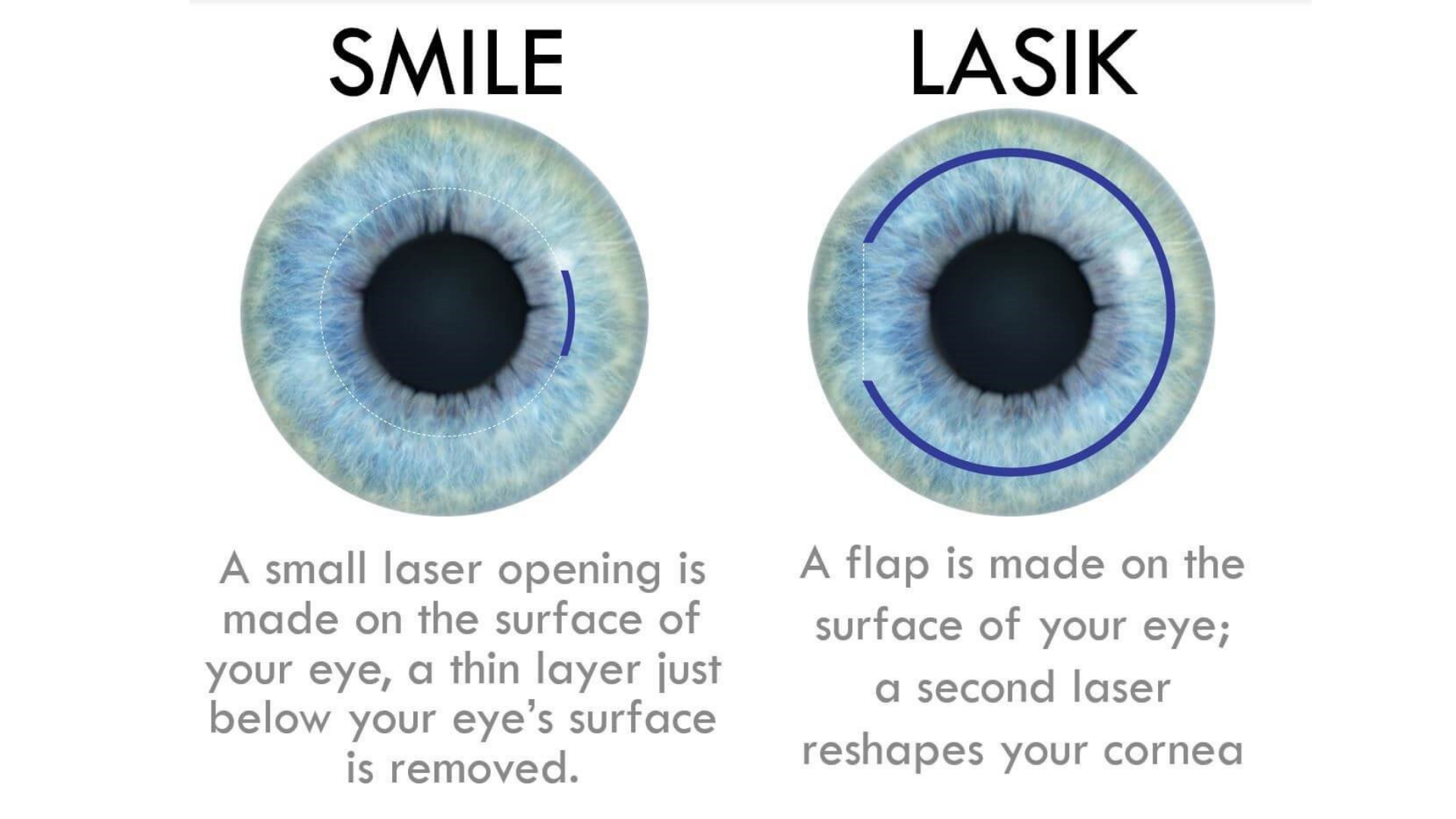 Лентикула. LASIK лазерный кератомилез. RELEX smile лазерная коррекция зрения. ФРК ласик Смайл.