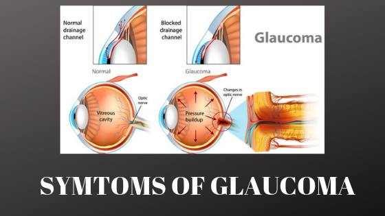 GLAUCOMA